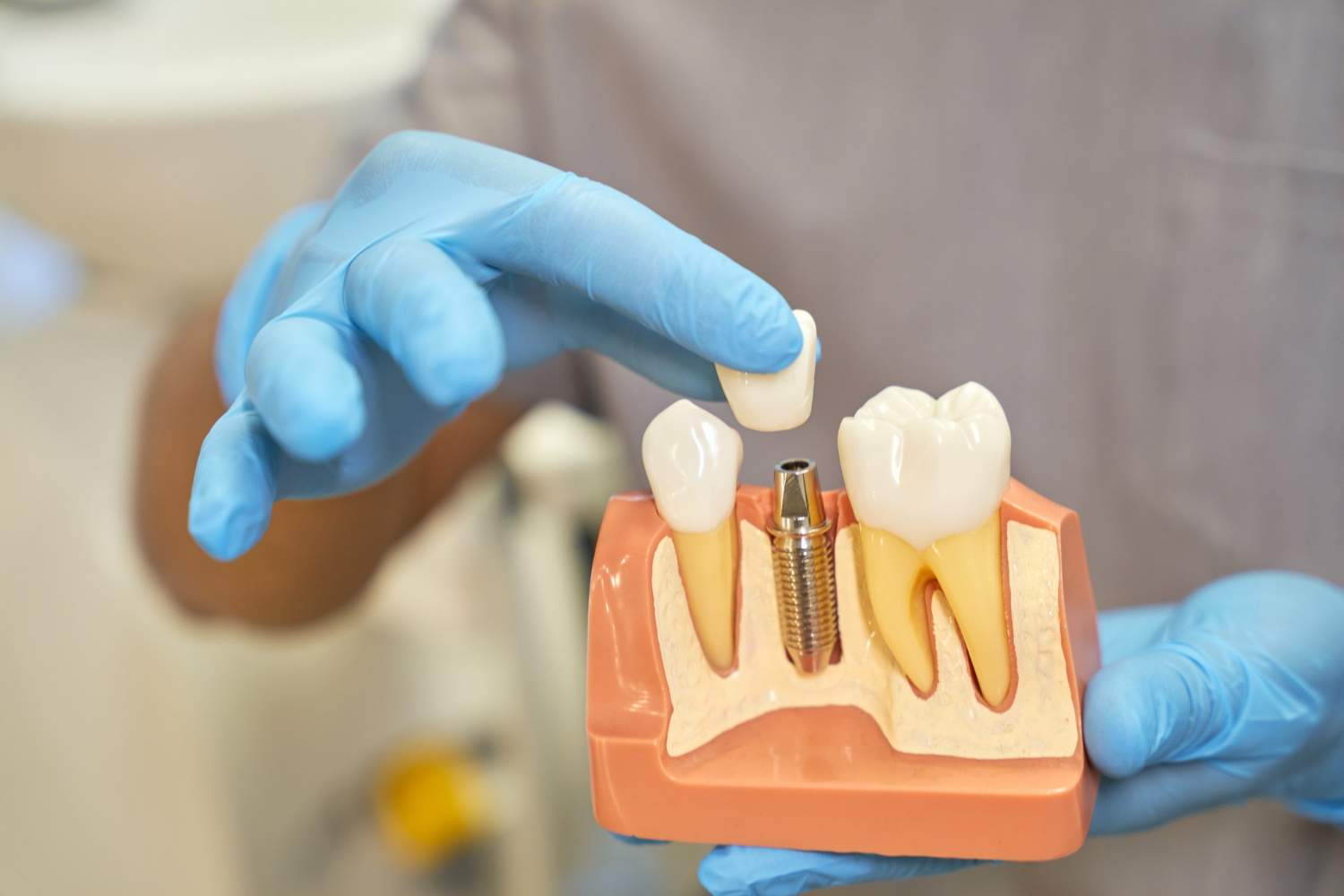 Especialistas en implantes dentales en Santander